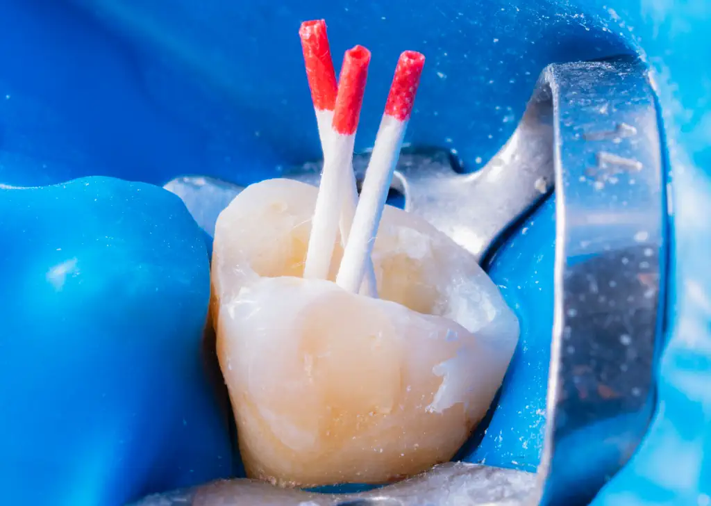 Root Canal Treatment – What is it ?